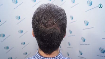 Injerto Capilar Frontal Coronilla Técnica FUE Grafts 4818 (11085 pelos) 30 34 RESULTADOS 6 MESES