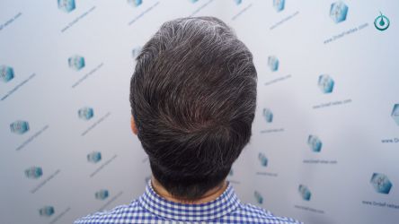 Injerto Capilar Frontal Coronilla Técnica FUE Grafts 4818 (11085 pelos) 31 35 RESULTADOS 6 MESES