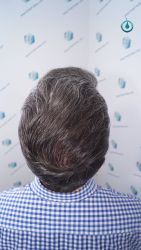 Injerto Capilar Frontal Coronilla Técnica FUE Grafts 4818 (11085 pelos) 32 36 RESULTADOS 6 MESES