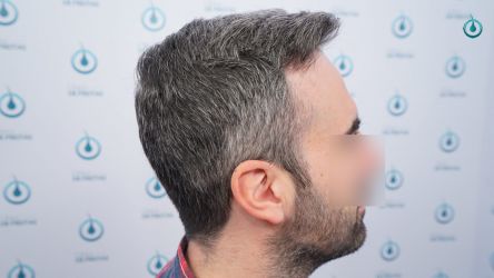 Injerto Capilar Frontal Coronilla Técnica FUE Grafts 4818 (11085 pelos) 33 38 RESULTADOS 12 MESES