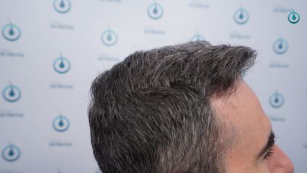 Injerto Capilar Frontal Coronilla Técnica FUE Grafts 4818 (11085 pelos) 34 39 RESULTADOS 12 MESES