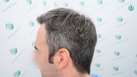 Injerto Capilar Frontal Coronilla Técnica FUE Grafts 4818 (11085 pelos) 4 3A ANTES DEL TRASPLANTE CAPILAR