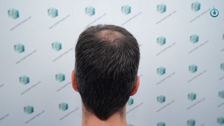 Injerto Capilar Frontal Coronilla Técnica FUE Grafts 4818 (11085 pelos) 5 4 ANTES DEL TRASPLANTE CAPILAR