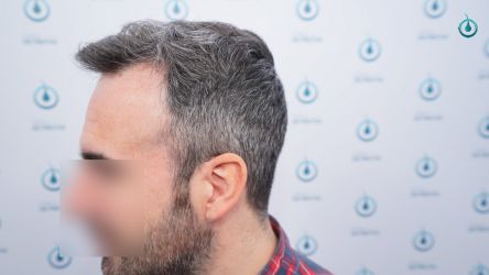 Injerto Capilar Frontal Coronilla Técnica FUE Grafts 4818 (11085 pelos) 35 40 RESULTADOS 12 MESES