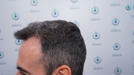 Injerto Capilar Frontal Coronilla Técnica FUE Grafts 4818 (11085 pelos) 36 41 RESULTADOS 12 MESES