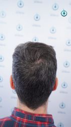 Injerto Capilar Frontal Coronilla Técnica FUE Grafts 4818 (11085 pelos) 37 42 RESULTADOS 12 MESES