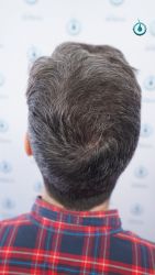 Injerto Capilar Frontal Coronilla Técnica FUE Grafts 4818 (11085 pelos) 38 43 RESULTADOS 12 MESES