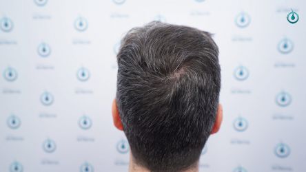 Injerto Capilar Frontal Coronilla Técnica FUE Grafts 4818 (11085 pelos) 39 44 RESULTADOS 12 MESES