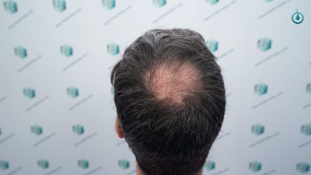 Injerto Capilar Frontal Coronilla Técnica FUE Grafts 4818 (11085 pelos) 6 5 ANTES DEL TRASPLANTE CAPILAR