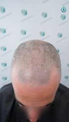 Injerto Capilar Frontal Coronilla Técnica FUE Grafts 4818 (11085 pelos) 7 7 DISEÑO LINEA INJERTO
