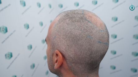 Injerto Capilar Frontal Coronilla Técnica FUE Grafts 4818 (11085 pelos) 9 9 DISEÑO LINEA INJERTO