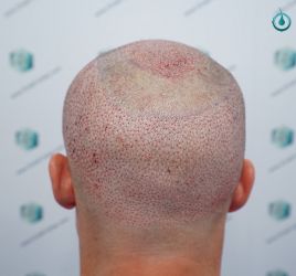 32 SEGUNDA CIRUGIA