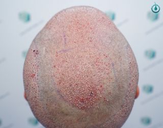 33 SEGUNDA CIRUGIA