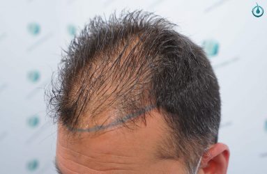 Injerto Capilar Frontal Coronilla Técnica FUE Grafts 4400 (11040 pelos) 8 10 DISEÑO LINEA INJERTO
