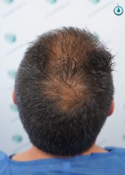 Injerto Capilar Frontal Coronilla Técnica FUE Grafts 4400 (11040 pelos) 9 11 DISEÑO LINEA INJERTO