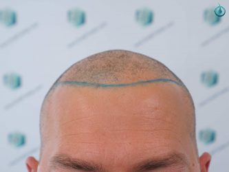 Injerto Capilar Frontal Coronilla Técnica FUE Grafts 4400 (11040 pelos) 10 12 DISEÑO LINEA INJERTO