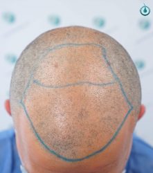 Injerto Capilar Frontal Coronilla Técnica FUE Grafts 4400 (11040 pelos) 11 13 DISEÑO LINEA INJERTO