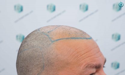 Injerto Capilar Frontal Coronilla Técnica FUE Grafts 4400 (11040 pelos) 12 14 DISEÑO LINEA INJERTO