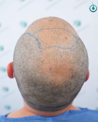 Injerto Capilar Frontal Coronilla Técnica FUE Grafts 4400 (11040 pelos) 14 16 DISEÑO LINEA INJERTO