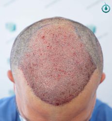 Injerto Capilar Frontal Coronilla Técnica FUE Grafts 4400 (11040 pelos) 15 18 TRASPLANTE CAPILAR