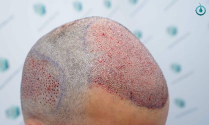 Injerto Capilar Frontal Coronilla Técnica FUE Grafts 4400 (11040 pelos) 16 19 TRASPLANTE CAPILAR