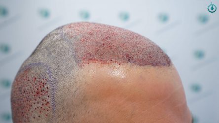 Injerto Capilar Frontal Coronilla Técnica FUE Grafts 4400 (11040 pelos) 17 19A TRASPLANTE CAPILAR