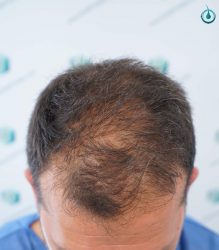 Injerto Capilar Frontal Coronilla Técnica FUE Grafts 4400 (11040 pelos) 1 2 ANTES DEL TRASPLANTE CAPILAR