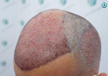 Injerto Capilar Frontal Coronilla Técnica FUE Grafts 4400 (11040 pelos) 18 20 TRASPLANTE CAPILAR