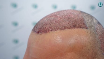 Injerto Capilar Frontal Coronilla Técnica FUE Grafts 4400 (11040 pelos) 19 20B TRASPLANTE CAPILAR