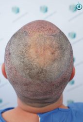 Injerto Capilar Frontal Coronilla Técnica FUE Grafts 4400 (11040 pelos) 20 21 TRASPLANTE CAPILAR