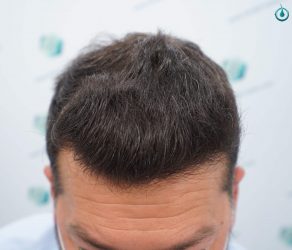 Injerto Capilar Frontal Coronilla Técnica FUE Grafts 4400 (11040 pelos) 21 22A RESULTADOS 12 MESES
