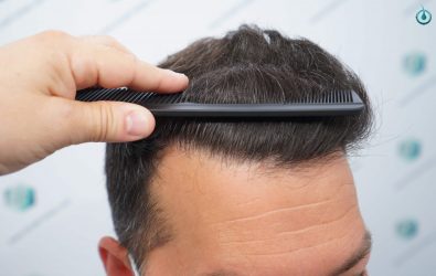 Injerto Capilar Frontal Coronilla Técnica FUE Grafts 4400 (11040 pelos) 22 23 RESULTADOS 12 MESES