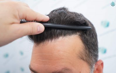 Injerto Capilar Frontal Coronilla Técnica FUE Grafts 4400 (11040 pelos) 23 24 RESULTADOS 12 MESES