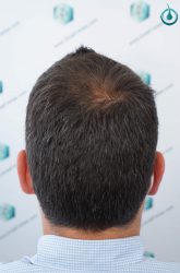 Injerto Capilar Frontal Coronilla Técnica FUE Grafts 4400 (11040 pelos) 24 25 RESULTADOS 12 MESES