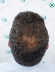Injerto Capilar Frontal Coronilla Técnica FUE Grafts 4400 (11040 pelos) 25 26 RESULTADOS 12 MESES