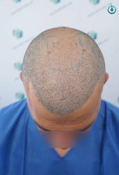 Injerto Capilar Frontal Coronilla Técnica FUE Grafts 4400 (11040 pelos) 27 28 DISEÑO LINEA INJERTO