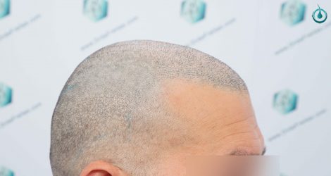 Injerto Capilar Frontal Coronilla Técnica FUE Grafts 4400 (11040 pelos) 28 29 DISEÑO LINEA INJERTO