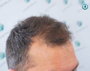 Injerto Capilar Frontal Coronilla Técnica FUE Grafts 4400 (11040 pelos) 2 3 ANTES DEL TRASPLANTE CAPILAR