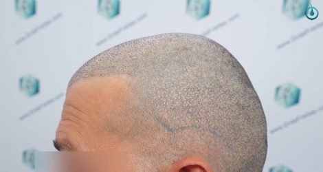 Injerto Capilar Frontal Coronilla Técnica FUE Grafts 4400 (11040 pelos) 29 30 DISEÑO LINEA INJERTO