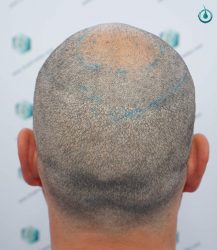 Injerto Capilar Frontal Coronilla Técnica FUE Grafts 4400 (11040 pelos) 30 31 DISEÑO LINEA INJERTO