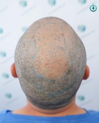 Injerto Capilar Frontal Coronilla Técnica FUE Grafts 4400 (11040 pelos) 31 32 DISEÑO LINEA INJERTO