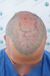 Injerto Capilar Frontal Coronilla Técnica FUE Grafts 4400 (11040 pelos) 32 34 TRASPLANTE CAPILAR