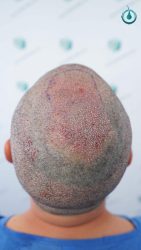 Injerto Capilar Frontal Coronilla Técnica FUE Grafts 4400 (11040 pelos) 33 35 TRASPLANTE CAPILAR