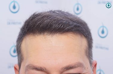 Injerto Capilar Frontal Coronilla Técnica FUE Grafts 4400 (11040 pelos) 34 38 RESULTADOS 2º CIRUGIA 12 MESES