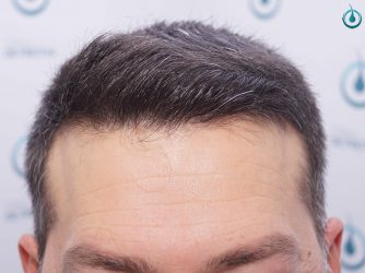 Injerto Capilar Frontal Coronilla Técnica FUE Grafts 4400 (11040 pelos) 35 39 RESULTADOS 2º CIRUGIA 12 MESES