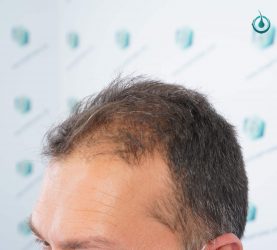 Injerto Capilar Frontal Coronilla Técnica FUE Grafts 4400 (11040 pelos) 3 4 ANTES DEL TRASPLANTE CAPILAR