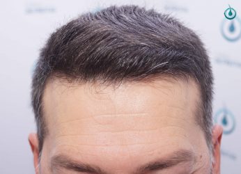 Injerto Capilar Frontal Coronilla Técnica FUE Grafts 4400 (11040 pelos) 36 40 RESULTADOS 2º CIRUGIA 12 MESES