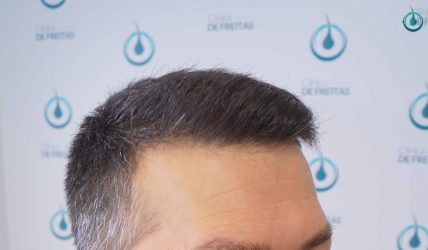 Injerto Capilar Frontal Coronilla Técnica FUE Grafts 4400 (11040 pelos) 37 41 RESULTADOS 2º CIRUGIA 12 MESES
