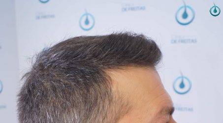 Injerto Capilar Frontal Coronilla Técnica FUE Grafts 4400 (11040 pelos) 38 42 RESULTADOS 2º CIRUGIA 12 MESES
