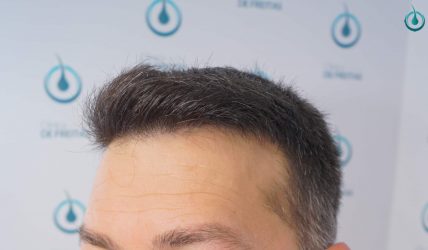 Injerto Capilar Frontal Coronilla Técnica FUE Grafts 4400 (11040 pelos) 39 43 RESULTADOS 2º CIRUGIA 12 MESES